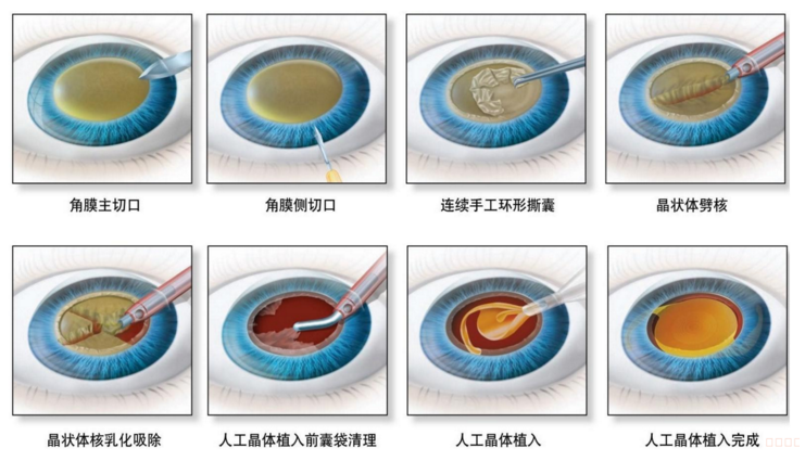 白内障超声乳化手术及人工晶体植入过程